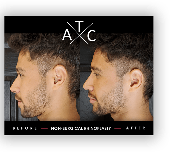 Non-Surgical Rhinoplasty Training Results 1